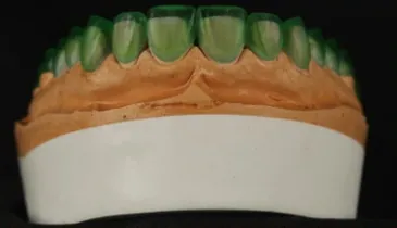 Diseño de carillas anteriores sobre modelo